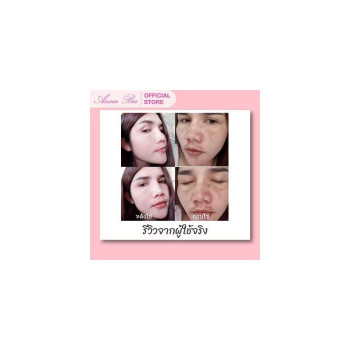 Anna Bee Gold Основная компания: Pure White Toner Toner Pure White. Растворите пятно на точке. Отрегулируйте кожу, чтобы она была гладкой, а также подавите выработку пигмента меланина, уменьшите темные пятна, веснушки, сделайте вид блеклым.